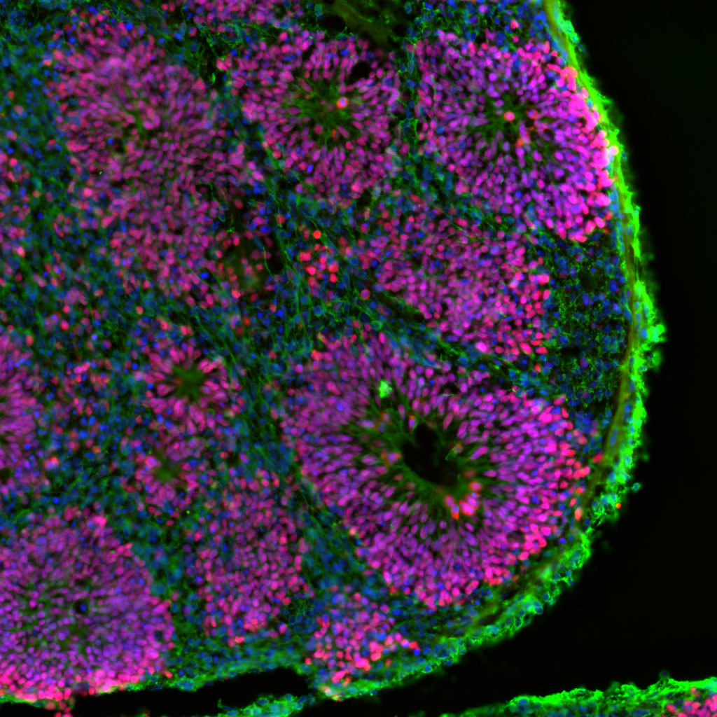 Three-Dimensional Model for Identifying Fragile X Treatments • Fragile ...